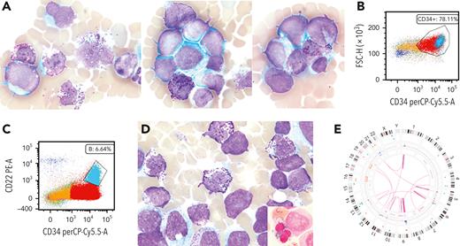 AML with mutated TP53, therapy-related, with basophilic differentiation, partial CD22, and ring sideroblasts ashpublications.org/blood/article/…