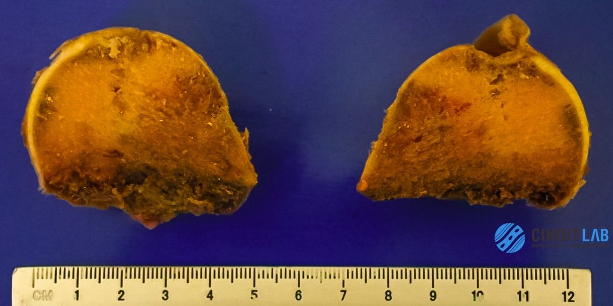 md_castaneda23's tweet photo. Osteonecrosis a vascular de cabeza de fémur. 🦴
Mujer de 59 años
#cinditlab https://t.co/ZBkcxBjbEB https://t.co/Kmza50NaD7