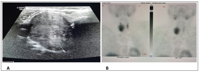 🧬 Extremely rare yet deadly: Parathyroid carcinoma often hides behind symptoms of benign disease, delaying diagnosis.

📊 A 10-year study from Oman reports just 4 cases—all with severe hypercalcemia &amp; sky-high PTH (1 case &gt;80× ULN).

Surgery saved lives, no recurrences in 2+