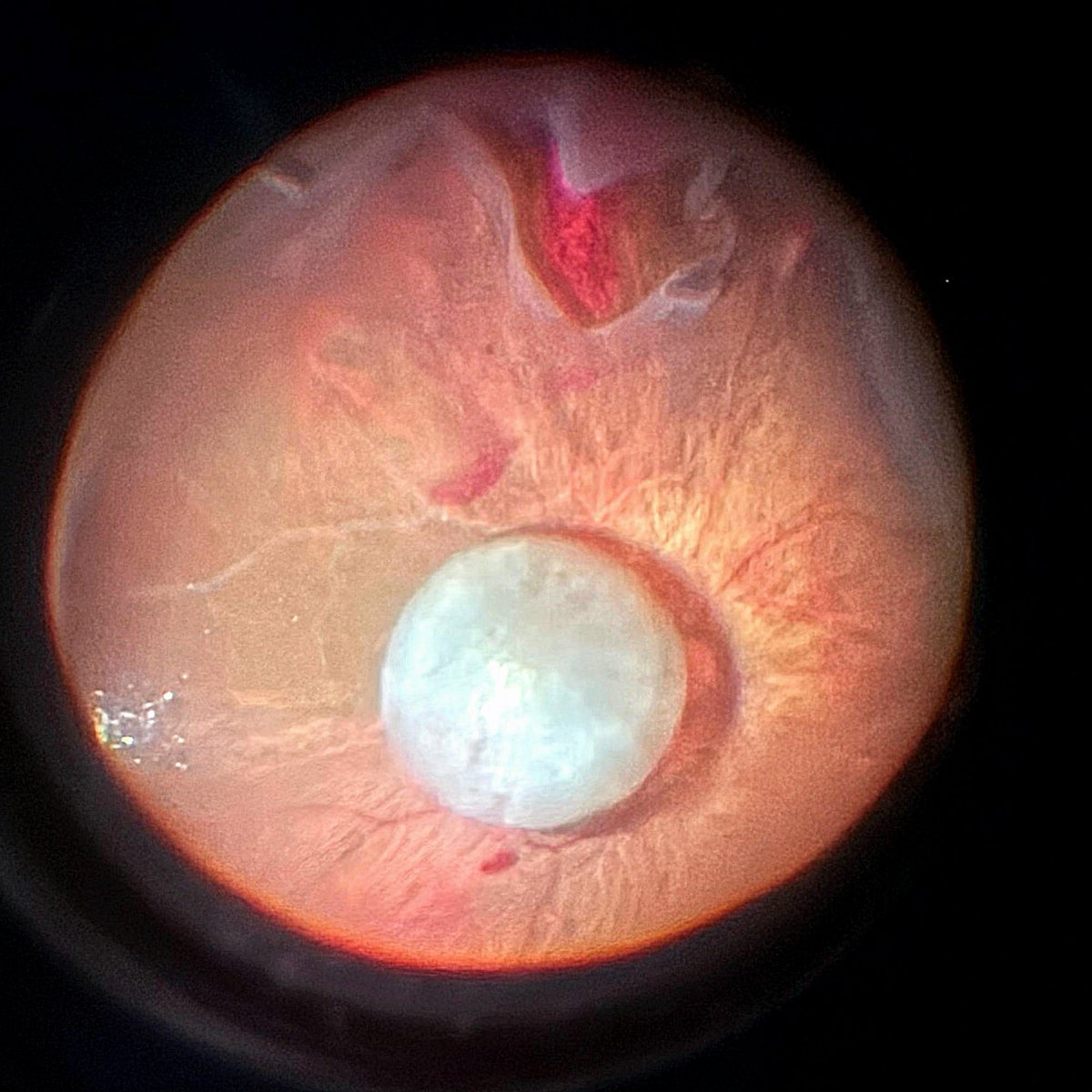 facovitrecto's tweet image. I'll use today's case as a friendly reminder for my fellow eye surgeons: if a nucleus drop is imminent, just *let it go*.

Heroic attempts to bring it back may cause more damage than good. Nothing good ever comes out of tugging on the vitreous base 👇🏻