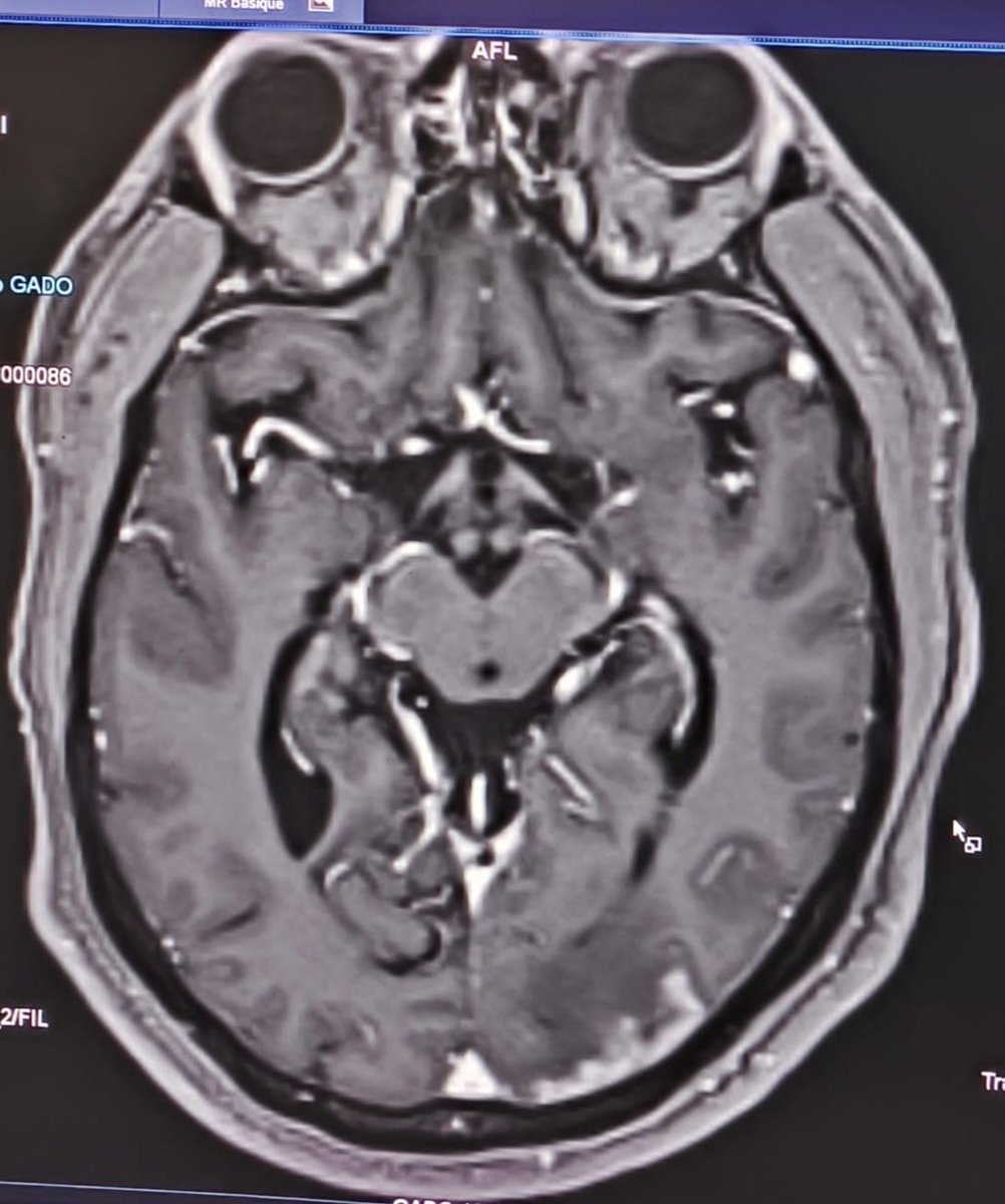 cherradi07's tweet photo. 33y old man.seizures since 25 y old. Visual disturbances.MRI: occipital lesion with meningeal thickening opposite. Stereotaxic biopsy. Red congo stain and grocott negative. Most microphotos on a next post.Your opinion please. https://t.co/pDbRCO7kp0