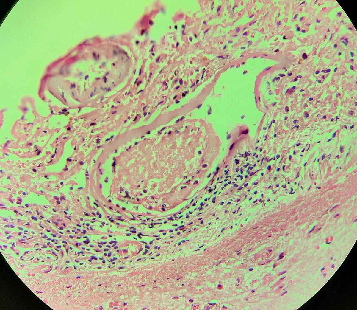 cherradi07's tweet photo. 33y old man.seizures since 25 y old. Visual disturbances.MRI: occipital lesion with meningeal thickening opposite. Stereotaxic biopsy. Red congo stain and grocott negative. Most microphotos on a next post.Your opinion please. https://t.co/pDbRCO7kp0