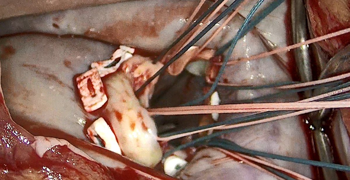 ahmed_osama350's tweet photo. 🫀 Successful minimally invasive mitral valve replacement in a 69-year-old with severe MR (EROA 0.52 cm², LVEF 58%, RVSP 45 mmHg). Excellent results &amp; faster recovery with endoscopic approach. #CardiacSurgery #ValveReplacement https://t.co/9pV6Sz72z6
