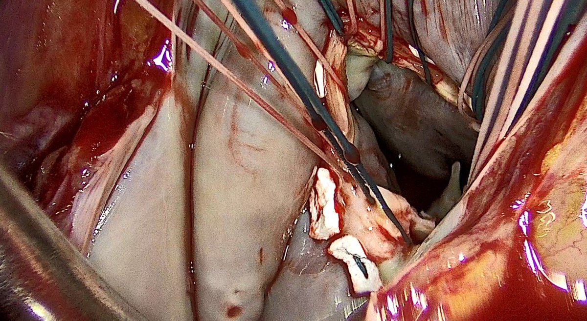 ahmed_osama350's tweet photo. 🫀 Successful minimally invasive mitral valve replacement in a 69-year-old with severe MR (EROA 0.52 cm², LVEF 58%, RVSP 45 mmHg). Excellent results &amp; faster recovery with endoscopic approach. #CardiacSurgery #ValveReplacement https://t.co/9pV6Sz72z6