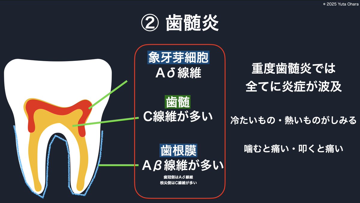yuuta023's tweet photo. 🦷2025/10/08 Dr向け

歯髄炎も全部性歯髄炎になると歯根膜まで炎症が波及し打診痛に反応があります💡

初期の歯髄炎では上部にのみ炎症が見られますが、

重度の歯髄炎になると根尖部まで炎症が波及し🔥

打診痛が出てきます（とても痛いことが多い）⚡️

上部の歯髄が壊死すると象牙芽細胞Aδ線維が伝える冷水痛は減り、温かいものに反応が強くなります（C線維）♨️

歯髄が壊死した後は冷水痛・温熱痛がなくなりますが、

慢性化した炎症が残るため、打診痛は残ることが多いです（鑑別診断に重要✅）

ただし、逆行性伝導による神経原生炎症が起きていたり、上顎洞炎になっていたりすると👃

隣在歯でも反応があることがあるのでそこの鑑別も重要になります⚠️

痛みの診査・診断ウェビナー（振り返り視聴つき）
https://t.co/LwdNBVn3Nr

歯科論文と歯科でのAI活用をわかりやすく教えるオンラインスクール
https://t.co/QFZNE5EAEa