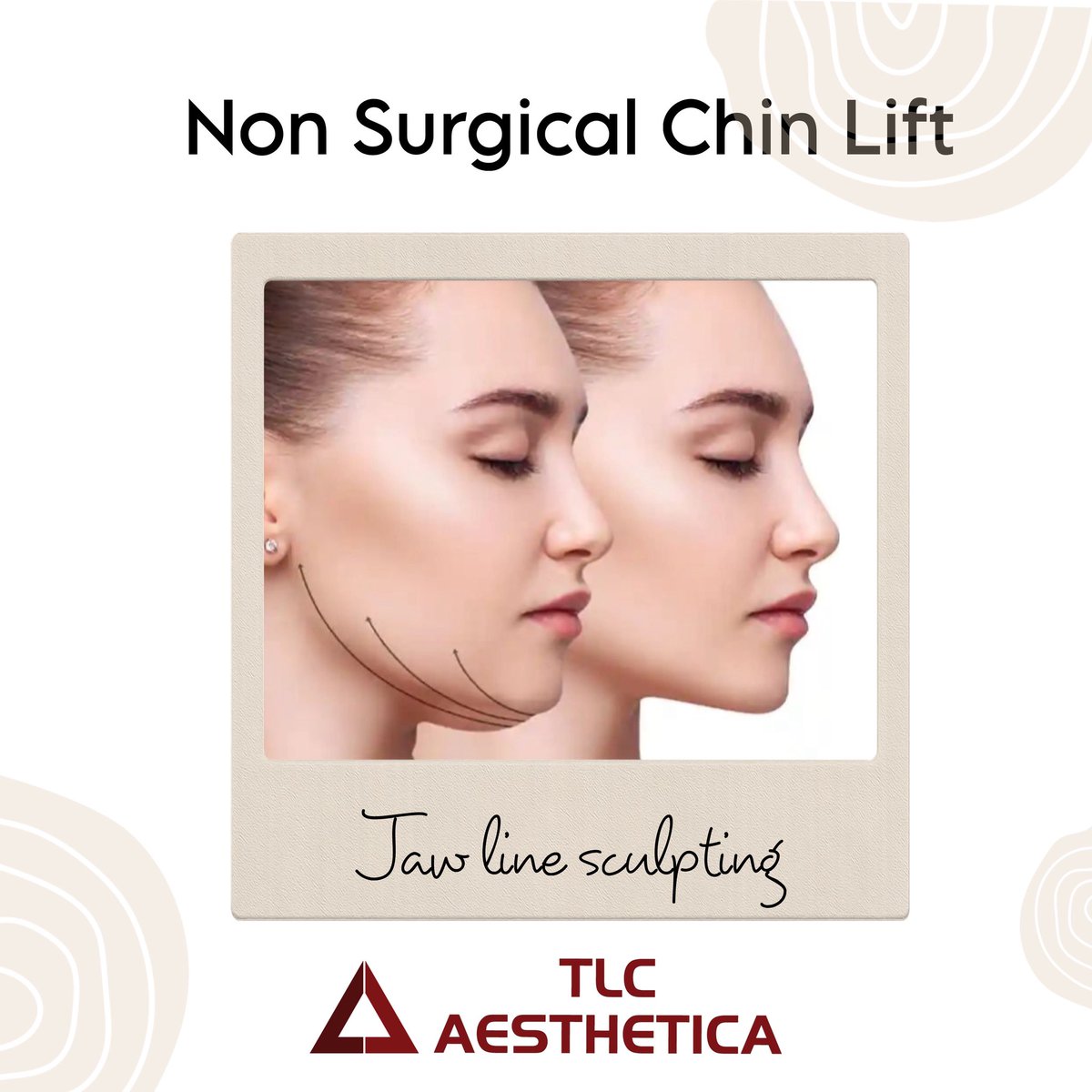 Non surgical chin lift #TLCaesthetica #ChinLift #JawlineContour #FaceSculpting #AestheticMedicine #NonSurgicalLift #lipo #dranoopgmohan #hdlipo