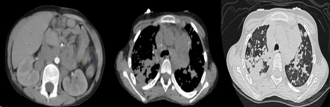 This week’s SPIN-POV: In a case of suspected CNS pediatric vasculitis, obtaining chest and abdominal imaging might often help in the diagnosis. This patient had generalised lymphadenopathy and lung parenchymal changes, suggesting an infectious pathology. Nodal biopsy revealed TB.