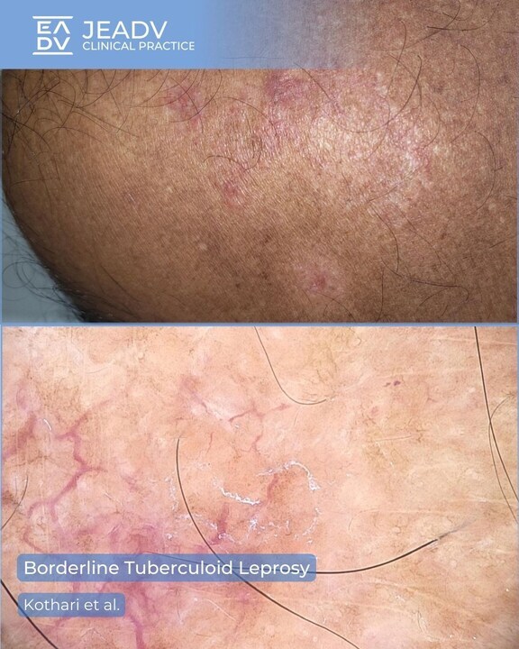 Kothari et al. report a man in his 50s with four erythematous plaques and hypopigmentation on his shoulder. Temperature sensation was impaired. Slit-skin smear was negative, but histopathology confirmed borderline #tuberculoid #leprosy.

👉 bit.ly/4mANUeg