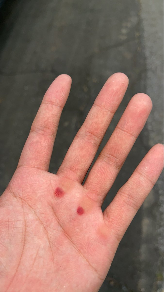 明日トナメなのにH鋼で懸垂してたらヒリヒリする