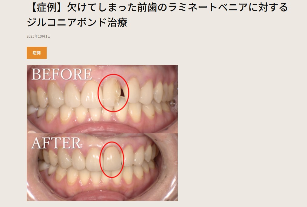 setagaya_DC's tweet photo. 症例をUPしました！
【症例】欠けてしまった前歯のラミネートベニアに対するジルコニアボンド治療
https://t.co/d97qkE2al7
＃せたがや歯科室 ＃セラミック #ラミネートべニア #前歯 ＃審美歯科 ＃ジルコニア
＃駅チカ歯医者 ＃駅前歯科 ＃松陰神社前 ＃世田谷線 ＃若林 ＃２４時間WEB予約受付中 https://t.co/ndEeUeD1Wx