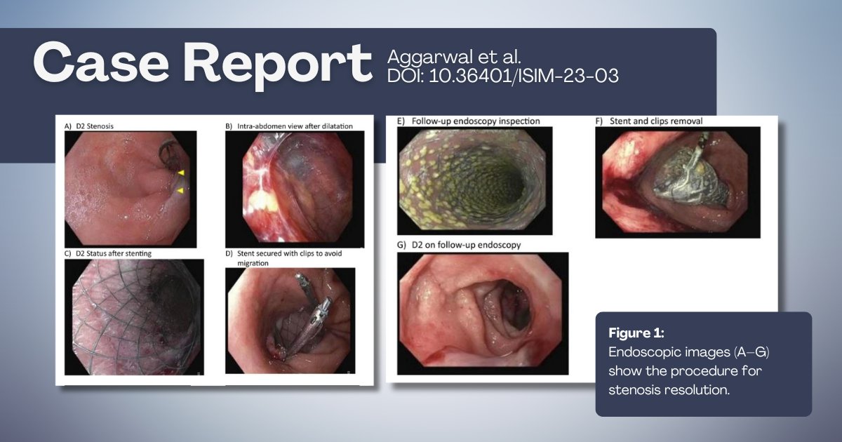 Case report emphasizes endoscopic stenting as an alternative to conventional surgical repair for duodenal perforation, by Aggarwal et al. doi.org/10.36401/ISIM-… #duodenalperforation #duodenalstent #endoscopy