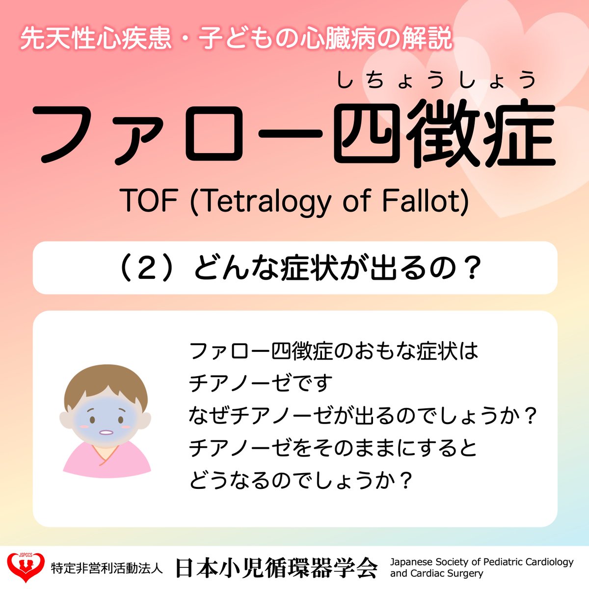JSPCCS's tweet image. 【公式Instagramより】

❤️子どもの心臓病の解説 ❤️

＼ファロー四徴症の症状／

ファロー四徴症のおもな症状はチアノーゼです。
どうしてチアノーゼが出るのでしょうか？

♡･････♡･････♡･････♡･････♡･････♡
詳しい内容は…
日本小児循環器学会一般向けホームページ…