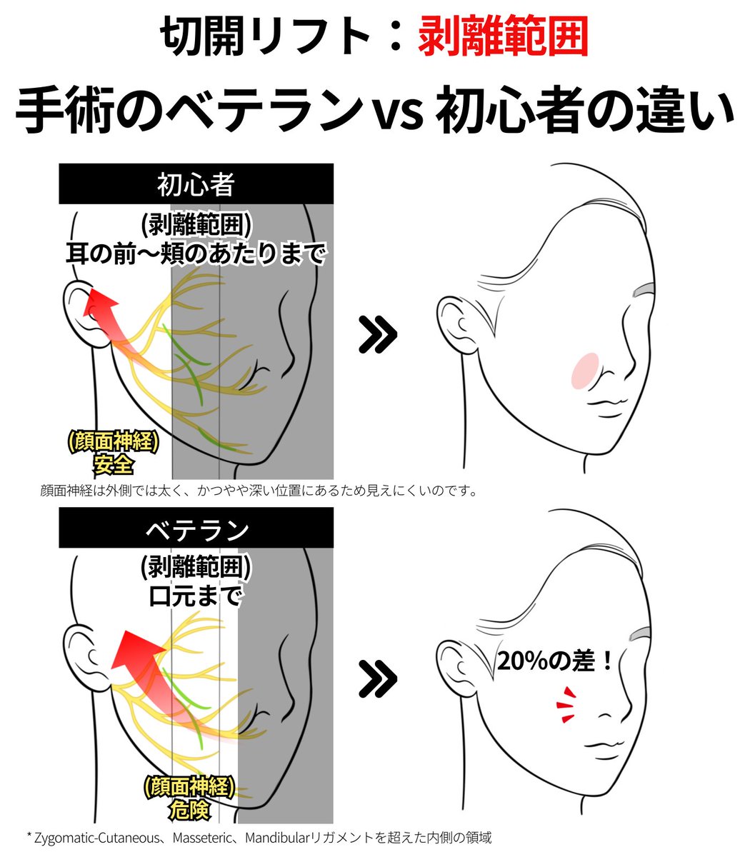 starlinejp's tweet photo. 【手術のベテラン vs 初心者の違い】
（切開リフト：剥離範囲）

顔面神経は外側では太く、かつやや深い位置にあるため見えにくいのです。
つまり手術による損傷のリスクが少なく安全な領域だということです。
しかし顔面神経は顔の内側へ進むにつれて徐々に細くなり、直接見えるようになります。
術者としては、神経損傷のリスクを避けるため、無理に内側までアプローチする必要はありません。

実際、安全な外側の靭帯だけを除去した場合と、内側まで処理した場合の手術結果には、約20％の差しかありません。

しかし、そのたった20％の差が、ベテランの手術か、初心者の手術かを分けると私は思います。

小鼻周囲の細か���シワや、口元のマリオネットラインのような細部まで、すべてを���麗に整えることができます。

#スターライン美容外科 #切開リフト #幹細胞注射 #脂肪吸引