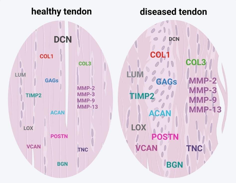 Physio Explored (@exploredphysio) on Twitter photo Healthy Vs Diseased Tendon
<a href="/Retlouping/">ɹǝʇlnoԀ pıʌɐᗡ 🚴🏻 🇺🇸 🇦🇺 🇬🇧</a> <a href="/TDekkersPhysio/">Thomas Dekkers | Spinal Specialist Physiotherapist</a> <a href="/DerekGriffin86/">Derek Griffin</a>
advanced.onlinelibrary.wiley.com/doi/full/10.10… Healthy Vs Diseased Tendon
<a href="/Retlouping/">ɹǝʇlnoԀ pıʌɐᗡ 🚴🏻 🇺🇸 🇦🇺 🇬🇧</a> <a href="/TDekkersPhysio/">Thomas Dekkers | Spinal Specialist Physiotherapist</a> <a href="/DerekGriffin86/">Derek Griffin</a>
advanced.onlinelibrary.wiley.com/doi/full/10.10…