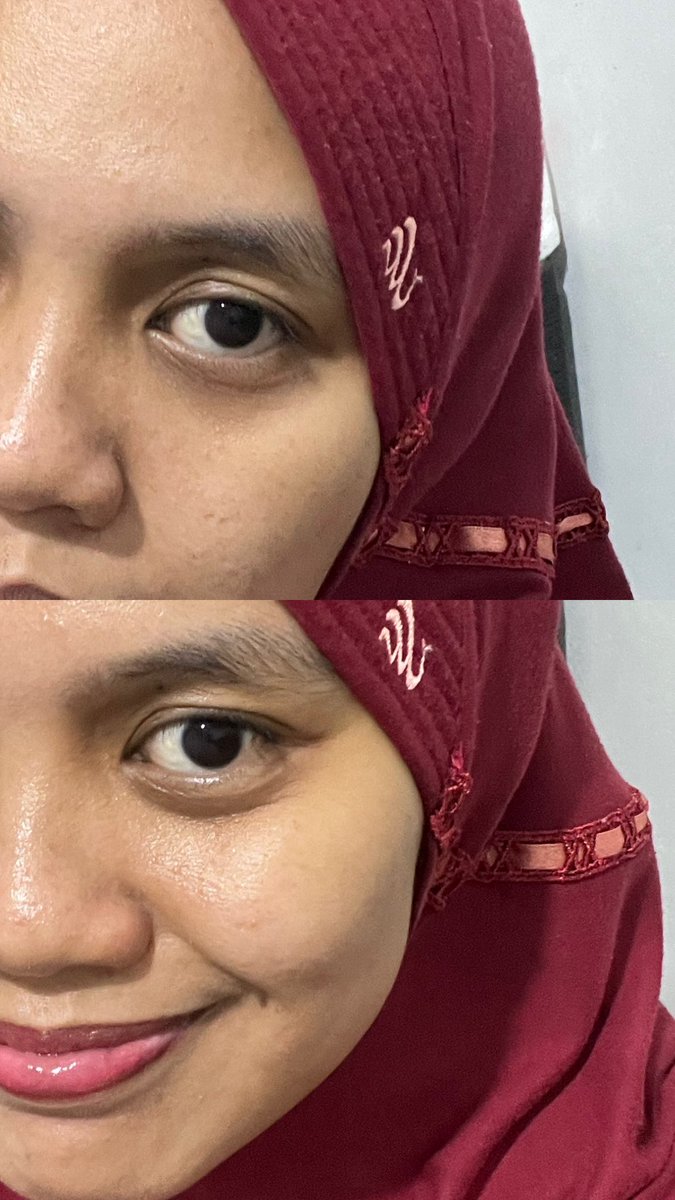 Cuma pake 1 skincare tp bisa keliatan lembab dan kulit jadi lebih terhidrasi🥹🤏

Btw fotonya no filter samsek ya! Yg atas belum pake, yg bawah udah.