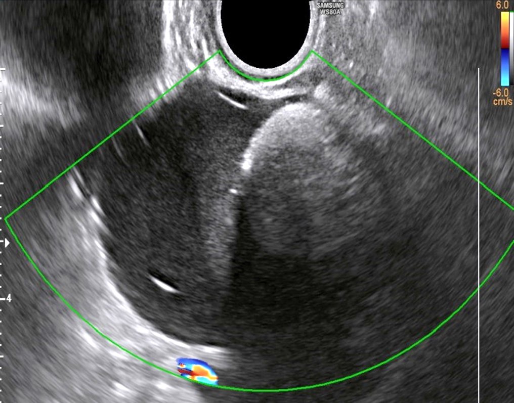 ISUOG's tweet photo. Ahead of our upcoming course, Assessment of adnexal masses using ultrasound, one of our expert speakers Dr Catherine Phillips has prepared a relevant #ISUOGEducation quiz question to get you all ready for this amazing course! 

Which of the following is a new O-RADS US lexicon term which was added in the 2022 update to improve specificity for some low-risk lesions? 

A. Shadowing 
B. Multilocular 
C. Solid component 
D. Dermoid 

Which answer do you think is correct? Comment your guesses below and come back next Friday for the right answer!

Register for our upcoming course: https://t.co/bOqYCSBL0O