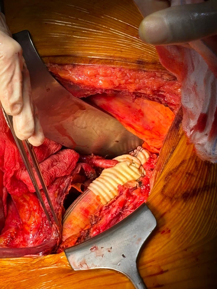 AruRobbie's tweet image. Loved my week in Rome learning from #aortic masters Prof Tshomba and Prof Tinelli at Gemelli. And to top it off with an excellent #multidisciplinary meeting! #vascularsurgery #AortaEd