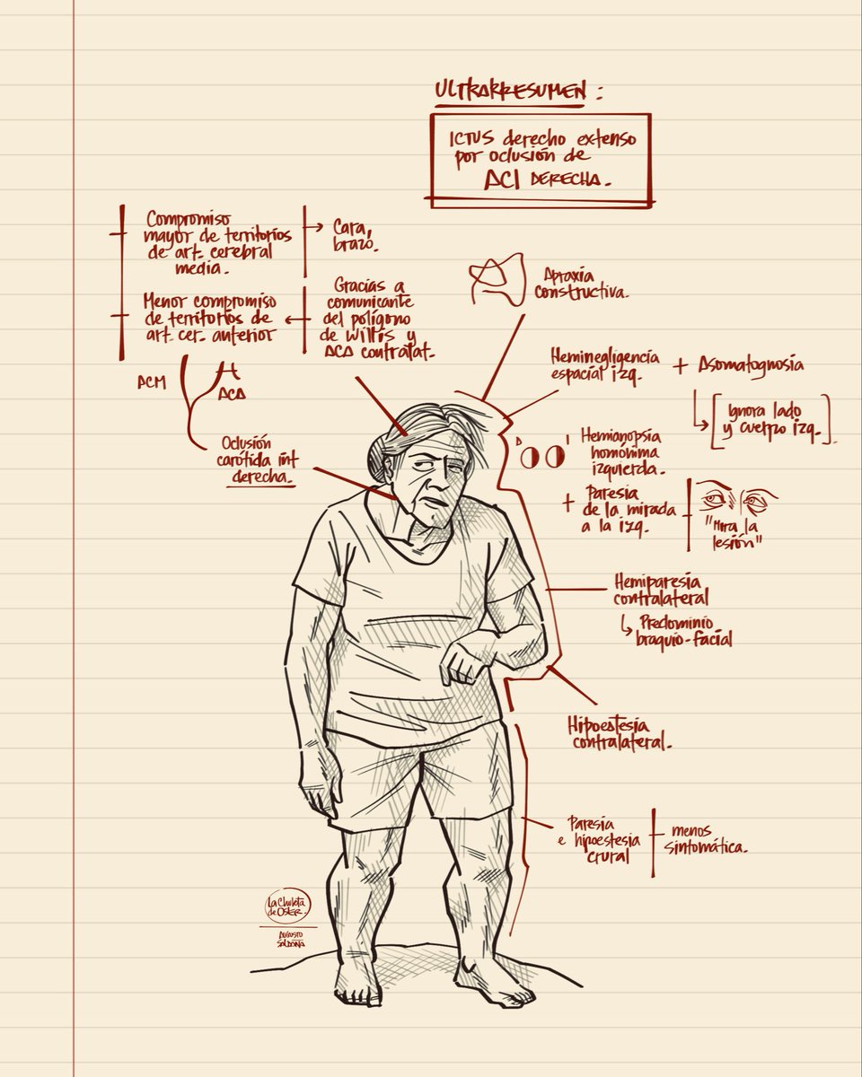 Ultrarresumen: ictus isquémico. Síndrome clínico por oclusión de carótida interna (territorio de ACM + territorio parcial de ACA ipsilateral).

#2mir26 #ENARM #FOAMUS #FOAMed #FOAMems #FOAMgp #MFyC #Urgencias #Neurologia #medicinainterna