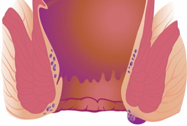 gastroendonews's tweet photo. New DDW 2025 algorithm guides Crohn’s perianal fistula care: check for abscess, drain if present, start TNF therapy, use imaging to assess complexity, and tailor advanced therapies as needed. https://t.co/1YTNVcxhcC #CrohnsDisease #Gastroenterology https://t.co/cEvjJnXn3f