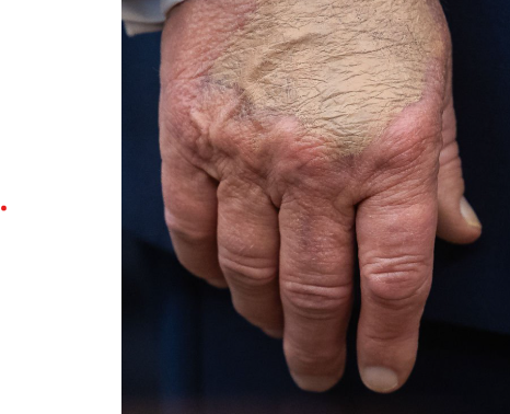 dexter_doggie's tweet photo. The last time Trump was seen in public, his right hand looked like this. The bruising was creeping down his middle finger, and his fingers look inflamed. #WheresTrump #TrumpIsUnwell #TrumpIsUnfitForOffice https://t.co/5XpGAOxSAQ