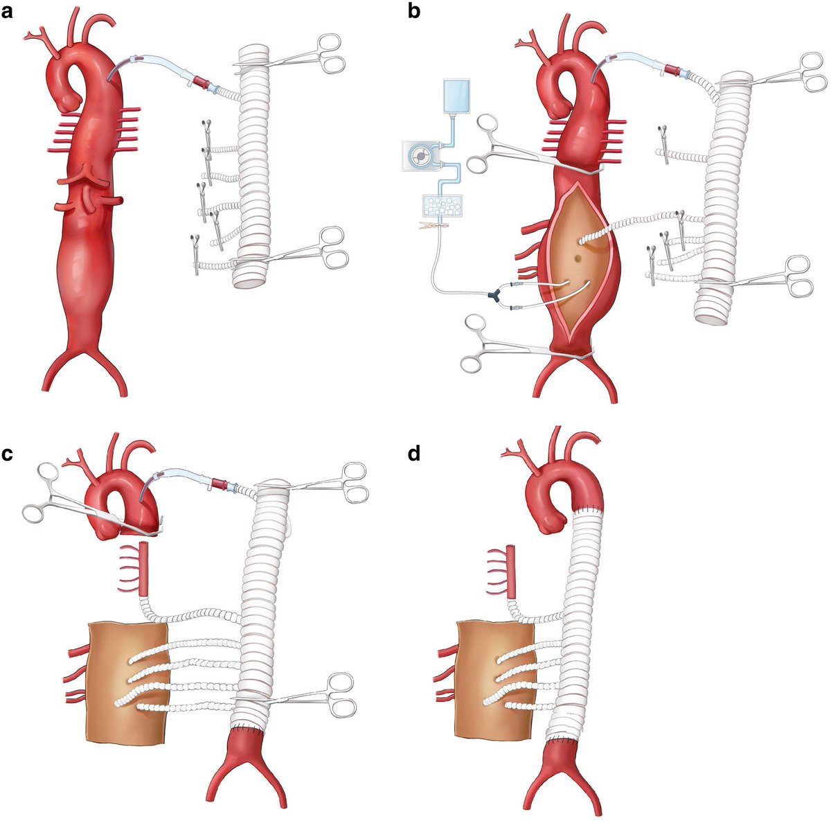 BjsOpen's tweet image. Evaluating normothermic artery bypass and visceral-anastomosis-first strategy in thoracoabdominal aortic aneurysm repair: propensity-weighted analysis
➡️doi.org/10.1093/bjsope…

The treatment of thoracoabdominal aortic aneurysm through open surgery is still an important method…