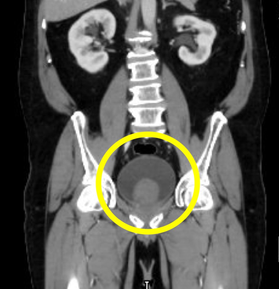 DoctorArriaga's tweet photo. Robotic simple prostatectomy 
@Urologos_UMANO en @CIMAHMO https://t.co/QEGGc8OGHn