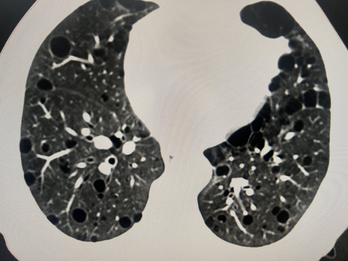 DevangBhavsarc's tweet photo. 49/M , case of Adeno Ca , lower one third (35-38 CM) non metastatic disease, need to start pre Op RT+ CT, CT scan Thorax shows multiple cyst in both lungs (>2 cm size max more then 100, normal PFT)
Expert comments @ACRORadOnc https://t.co/zv9o0ilR9D