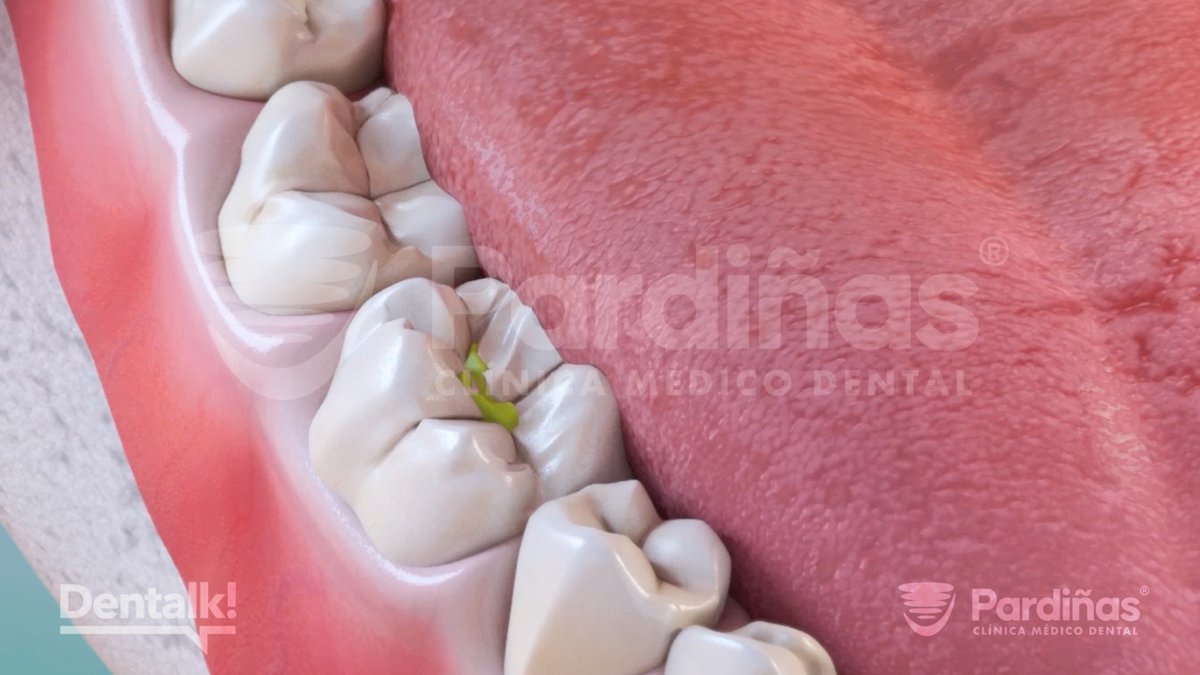 ClinicaPardinas's tweet image. 🦷La #caries dental es una de las enfermedades bucodentales más comunes.

📖 En nuestro nuevo artículo te explicamos qué es, cómo se forma y, lo más importante, cómo puedes evitarla.

🔗 Lee el artículo completo: clinicapardinas.com/es/caries-dent…

#ToothDecay #Cavities #CarieDental