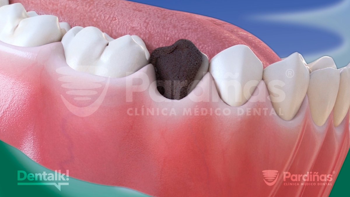 ClinicaPardinas's tweet image. 🦷La #caries dental es una de las enfermedades bucodentales más comunes.

📖 En nuestro nuevo artículo te explicamos qué es, cómo se forma y, lo más importante, cómo puedes evitarla.

🔗 Lee el artículo completo: clinicapardinas.com/es/caries-dent…

#ToothDecay #Cavities #CarieDental