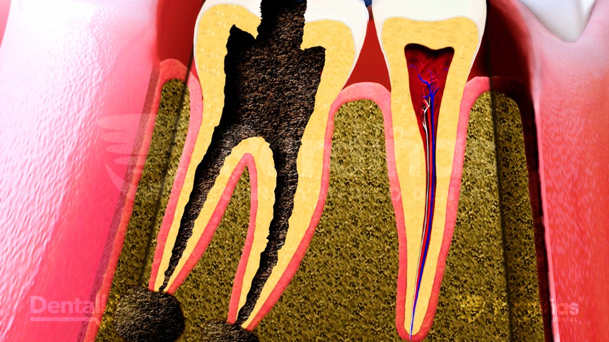 ClinicaPardinas's tweet image. 🦷La #caries dental es una de las enfermedades bucodentales más comunes.

📖 En nuestro nuevo artículo te explicamos qué es, cómo se forma y, lo más importante, cómo puedes evitarla.

🔗 Lee el artículo completo: clinicapardinas.com/es/caries-dent…

#ToothDecay #Cavities #CarieDental