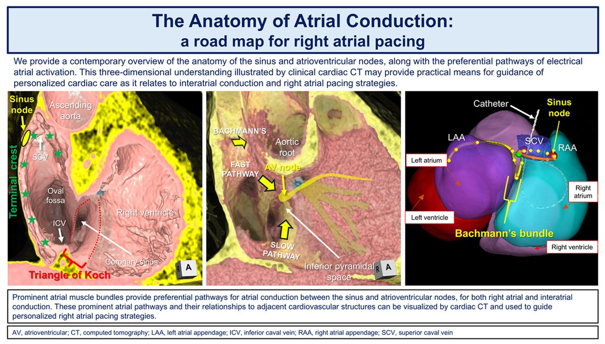 hrs_journal's tweet image. The anatomy of atrial conduction: a review of anatomical landmarks integrated with computed tomographic virtual dissection to provide a road map for right atrial pacing #OpenAccess 

heartrhythmjournal.com/article/S1547-…