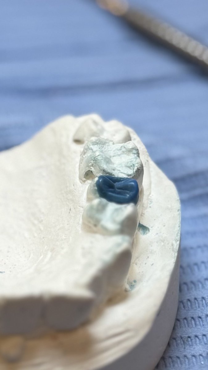 Becoming both a dentist and a dental technician at the same time☺️

Prepped a #15 wax-up for my patient