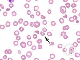 Weekend digest: name the most likely pathogen

- Presents with diarrhea
- Abdominal pain
- Renal failure

Image credit: ASH