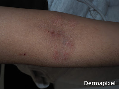 🧐"Picores adolescentes". Cas de dermatologia pediàtrica al blog #Dermapixel de <a href="/rosataberner/">Rosa Taberner</a> cutt.ly/yrBStyNG