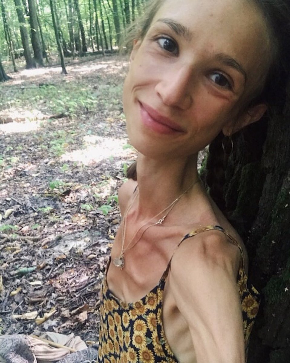 izzyzerocals's tweet image. Thread para o ed twt sobre a polonesa que morreu de TA com 22kg