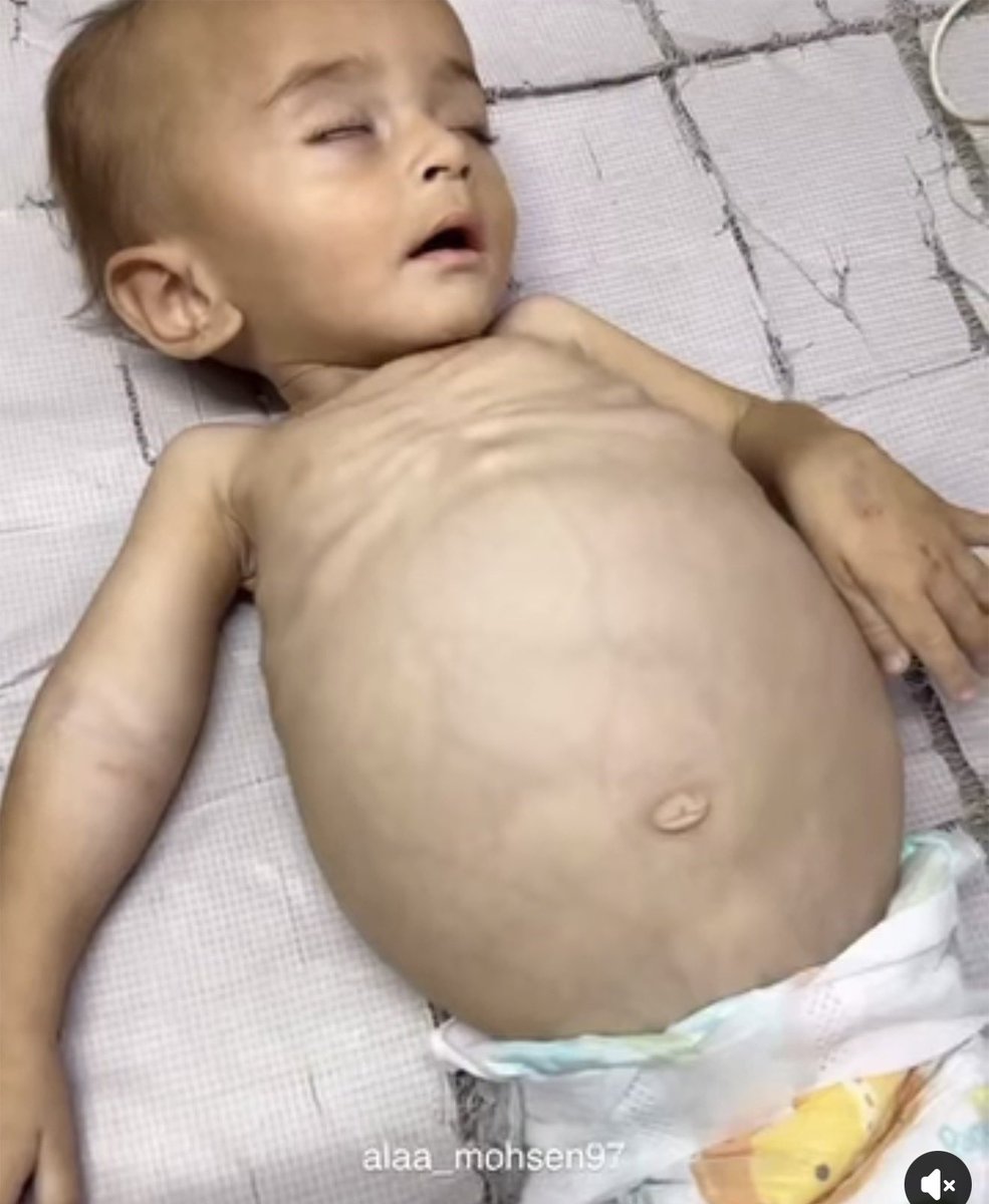 Infant Sajid Ahmed Abu Saqr, only 9 months old, is suffering from severe malnutrition and life-threatening complications. He was born with just one kidney, and now faces bone softening, enlarged brain ventricles, and intestinal problems. His weight continues to decline, and he