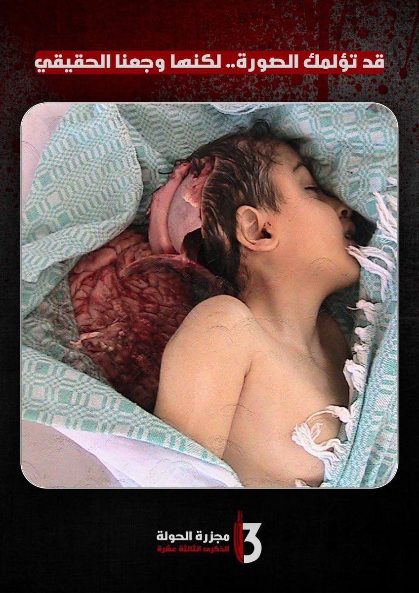 ⁨هذه صورة لبنت لا تتجاوز الستة سنوات
 من الحولة في حمص .
 قام النصيريون المجرمون الطائفيون بفتح رأسها بالسواطير في مذبحة الحولة الشهيرة ،  وإخراج دماغها منه.

 أنا أريد أن أسألكم؟؟

هل يوجد على سطح الكرة الأرضية حتى من عبدة الشياطين ،حتى من عبدة فروج العاهرات من يفعل هذا الفعل