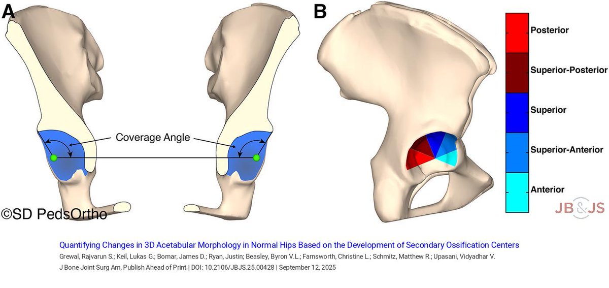 jbjs's tweet image. &quot;Quantifying Changes in 3D Acetabular Morphology in Normal Hips Based on the Development of Secondary Ossification Centers&quot; by Grewal et al. 

bit.ly/48KDNQq

#hip #basicscience #pediatrics