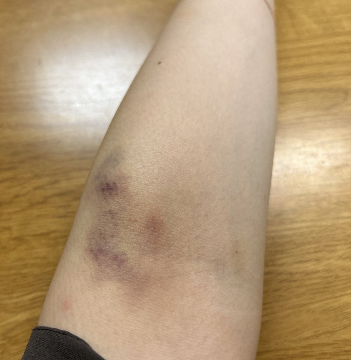 週末あやぽん♫

通院の採血後2日経過。
暴行されたんかってぐらい内出血がすごいw なんか恥ずかしいからとりあえず長袖着ることにします。笑
この後もっとひどくなるのかなー

#難病
#皮膚筋炎
