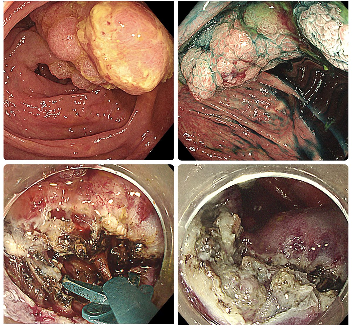 ben_sukit's tweet image. ESD of a 6-cm sessile polyp involving the IC valve in a cirrhotic patient. It was difficult due to the location and bleeding. My tips are 1) start from the IC valve, 2) scissor-type knife is better than needle-type knife for hemostasis in this challenging case. 👍

#ESD