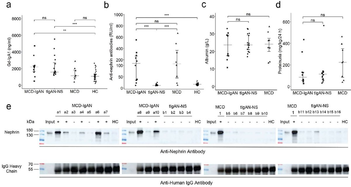 Now online in <a href="/NDTsocial/">NDT</a>

Anti-nephrin antibodies in patients with IgAN and nephrotic syndrome 

🧐The majority of MCD-IgAN patients were positive for circulating anti-nephrin antibodies!

▶️academic.oup.com/ndt/article-ab…
