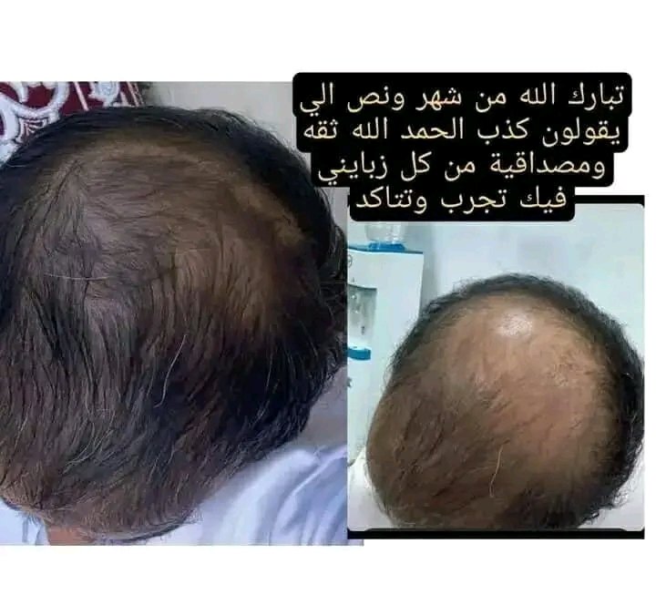 mbdw378591's tweet image. ✨ بخـاخ إنبات الشعر ✨
الحل الطبيعي لتكثيف الشعر وملء الفراغات وظهور البيبي هير 
✅ شعر أكثف وأقوى
✅ بيبي هير جديد يملأ الفراغات
✅ تركيبة طبيعية آمنة ومجرب
🌱 غني بالمكونات الطبيعية والمغذيات اللي بتقوي بصيلات الشعر من الجذور وتمنحك شعر صحي وحيوي.
#اقوي__عرض__لزراعه__الشعر