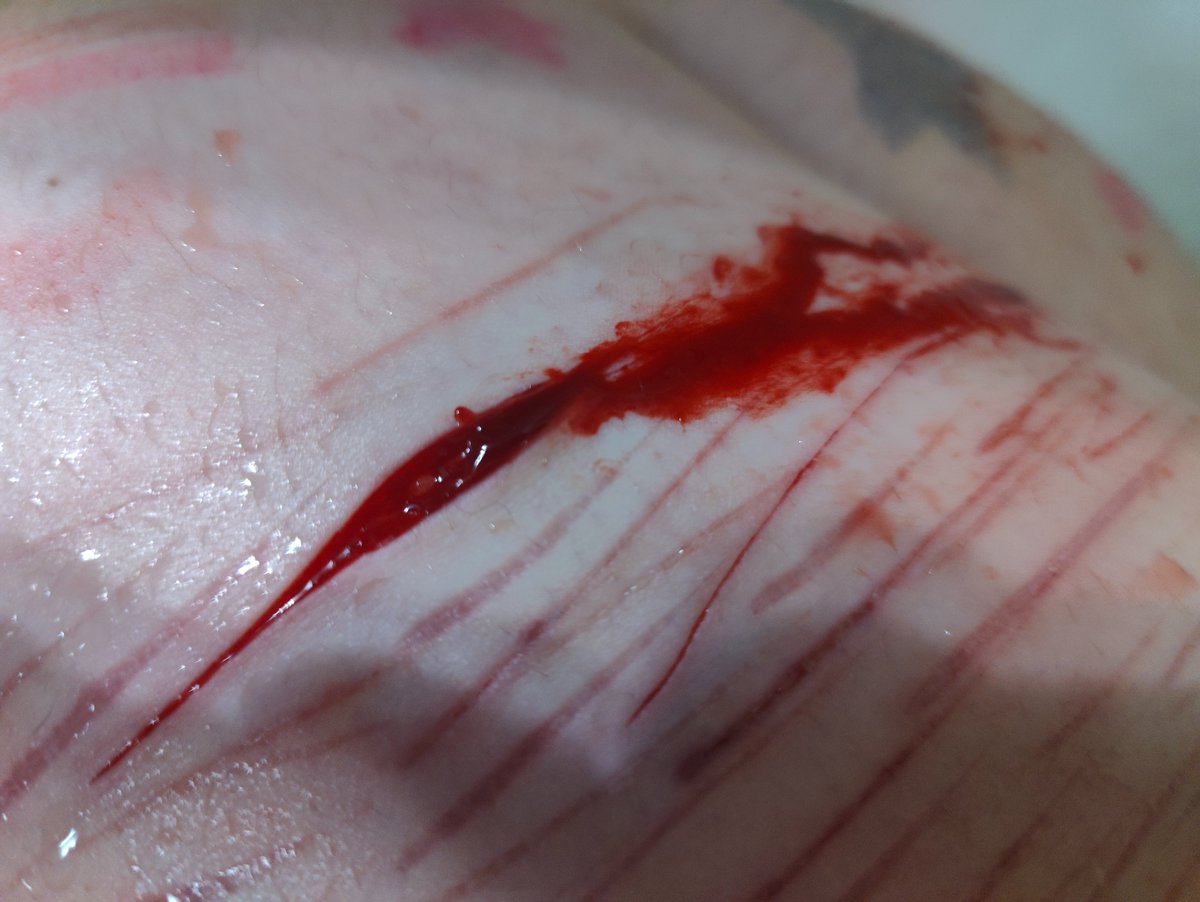 _Kukira's tweet photo. Could this be bb beans? I can't tell bc it's so bl//dy:( and VERY SMALL dent 😭#sh #shtwt #edtwt #911twt #selfharmtw https://t.co/v6CRyFUhPM
