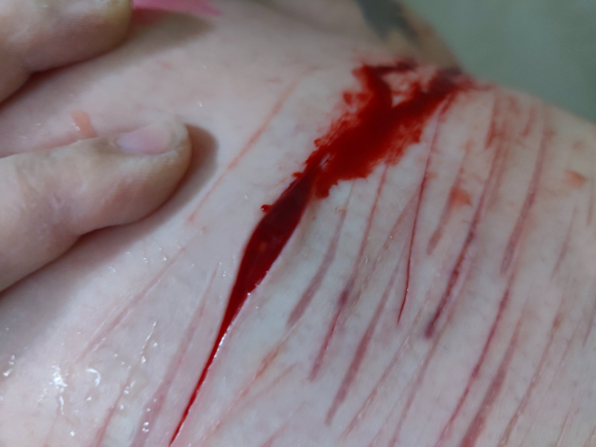_Kukira's tweet photo. Could this be bb beans? I can't tell bc it's so bl//dy:( and VERY SMALL dent 😭#sh #shtwt #edtwt #911twt #selfharmtw https://t.co/v6CRyFUhPM