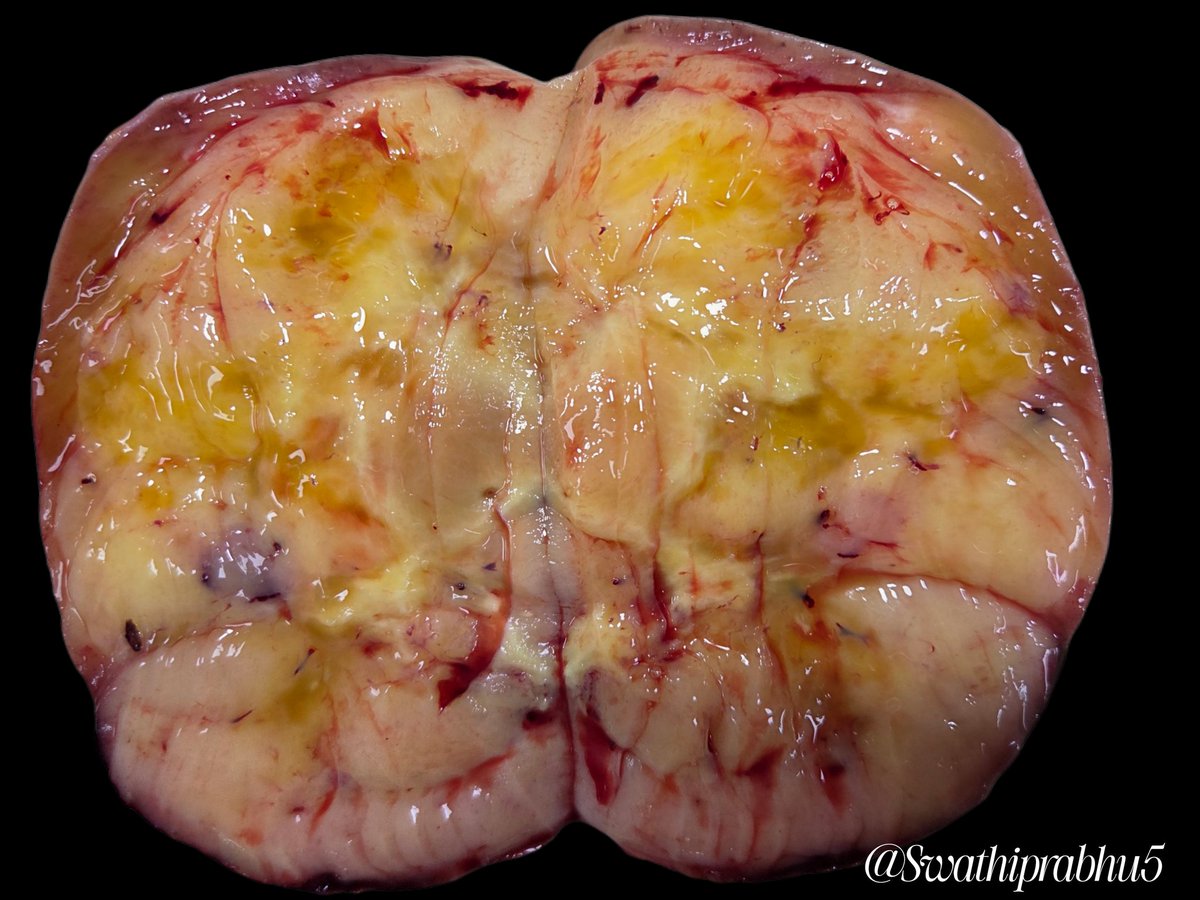 Swathiprabhu5's tweet photo. Subdiaphragmatic mass. Differentials? #pathology #gross #pathologists https://t.co/HBwq6U5hNc