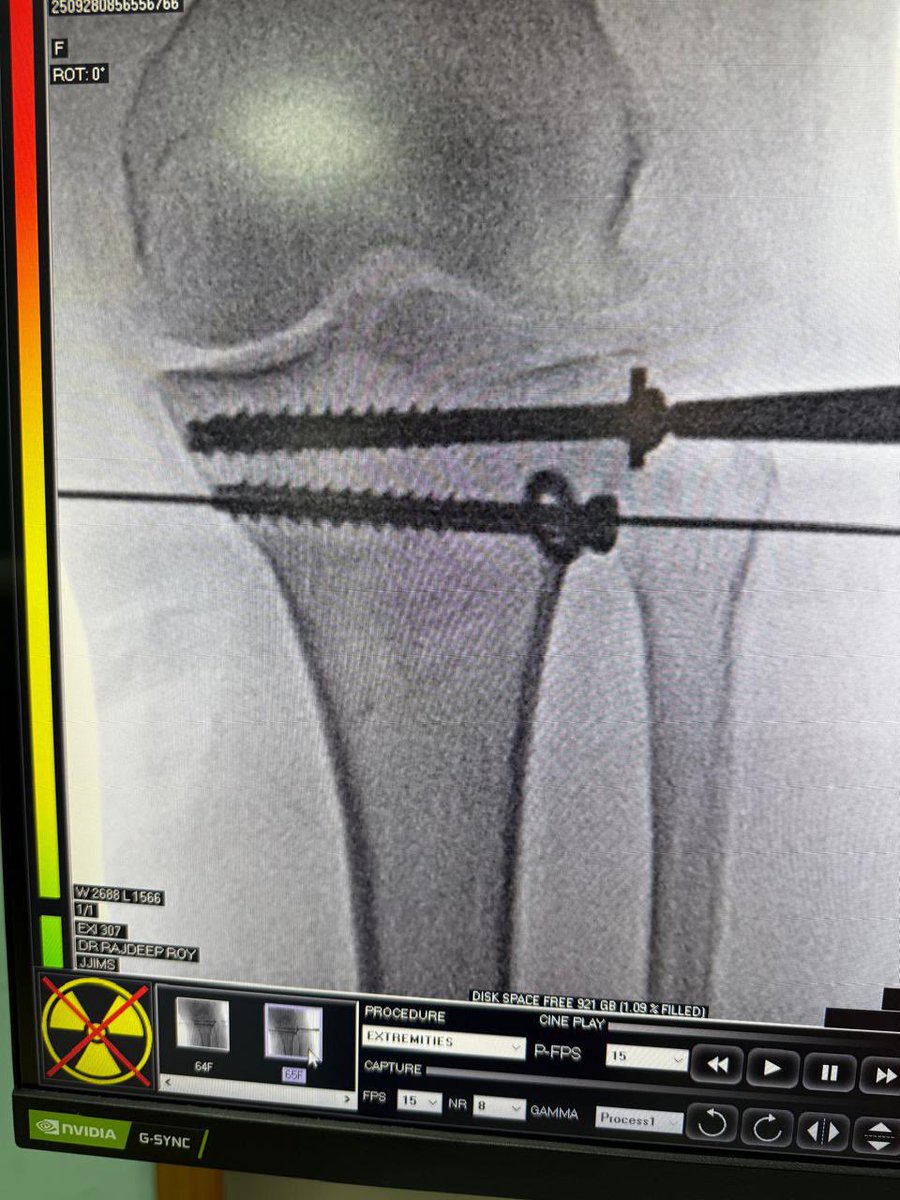 JJIMS_Silchar's tweet image. Minimally Invasive Percutaneous surgeries are being performed by our Ortho teams regularly keeping in mind early mobilisation , less hosp stay and minimal cost.

@drrajdeeproy 
#IntraArticularFracture