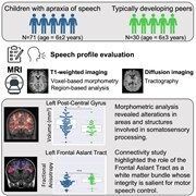 braincomms's tweet image. Bosco et al. studied children with apraxia of speech, finding cerebral structural differences in key regions for speech/language and motor tasks. These brain changes correlate with speech severity. Full article 👉 buff.ly/8qF6jU9