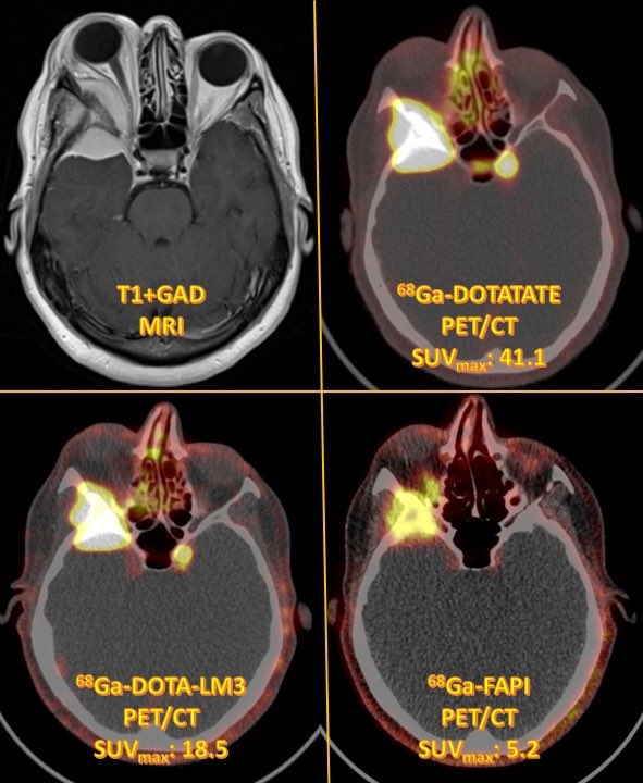 ⁶⁸Ga-DOTATATE PET— the King of meningioma imaging 👑

LM3 and FAPI are rising stars, but DOTATATE still reigns supreme in management .

#Meningioma
 #PET
 #DOTATATE
 #LM3
#FAPI
 #Theranostics