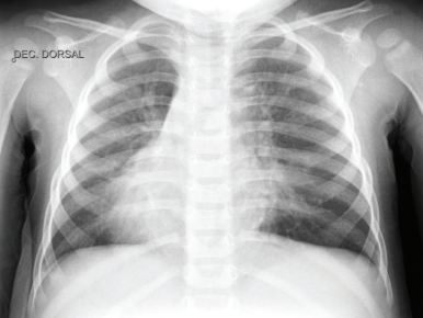 Primary Ciliary Dyskinesia often hides in plain sight — chronic sinusitis, recurrent infections, neonatal distress.

This case adds a new FOXJ1 mutation to the map, reminding us: clinical suspicion still opens the door to genetic answers.

Early diagnosis = better lungs, better