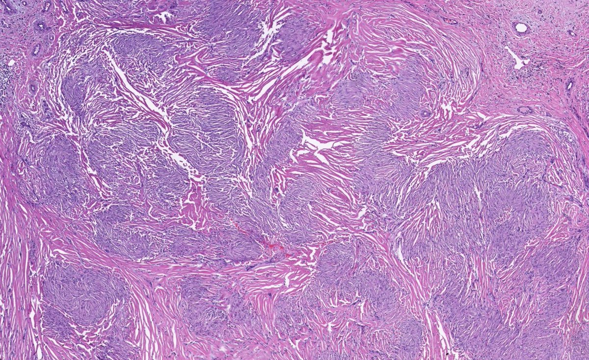 JMGardnerMD's tweet image. Red-purple skin nodule on elbow. Diagnosis?
Answer ✅ youtu.be/Gbc9RHe5Kko?si…
What systemic issues can be associated with this? Digital slide & info: kikoxp.com/posts/24378
#pathology #pathologists #pathTwitter #dermpath #dermatology #dermatologia #dermtwitter